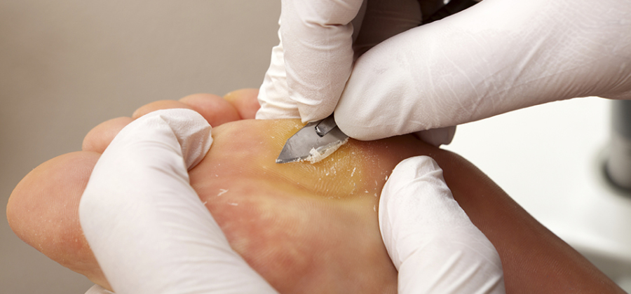 Hard Skin On Toe - Corns & Callous - Prahran Foot Clinic / I